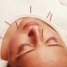 Acupunctuur, IVF en vruchtbaarheidsproblematiek