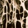 Osteoporose en depressie